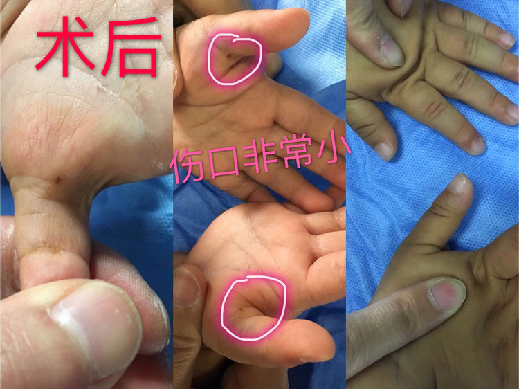 手术治疗幼儿双拇指狭窄性腱鞘炎